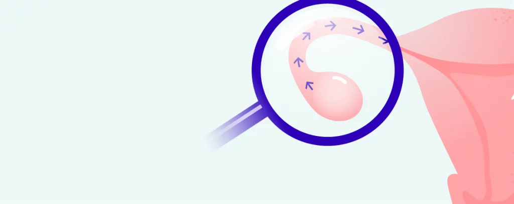 Test of fallopian tube patency hero-image